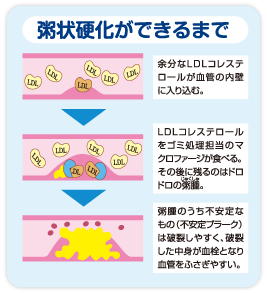 粥状硬化ができるまで