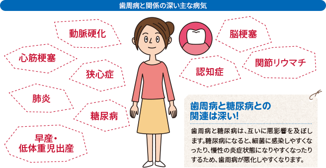 歯周病と関係の深い主な病気動脈硬化・心筋梗塞・狭心症・肺炎・糖尿病・早産・低体重児出産・脳梗塞・認知症・関節リウマチ