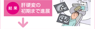 結果:肝硬変の初期まで進展
