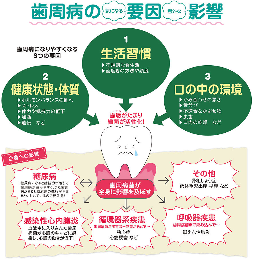 歯周病の気になる要因 意外な影響